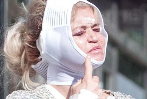 Plastik əməliyyat etdirən aktrisa tanınmaz halda - fotolar 