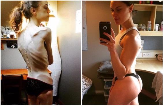 Anoreksiya xəstəsi olmuşdu - bir də son halını görün