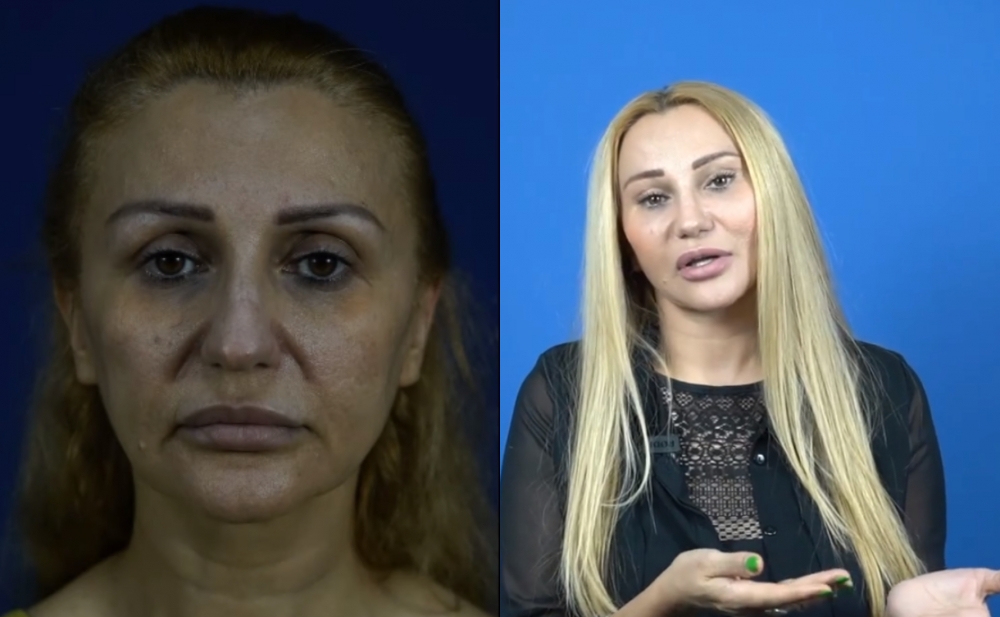 53 yaşlı azərbaycanlı prodüser plastik əməliyyatla dəyişdi - Fotolar