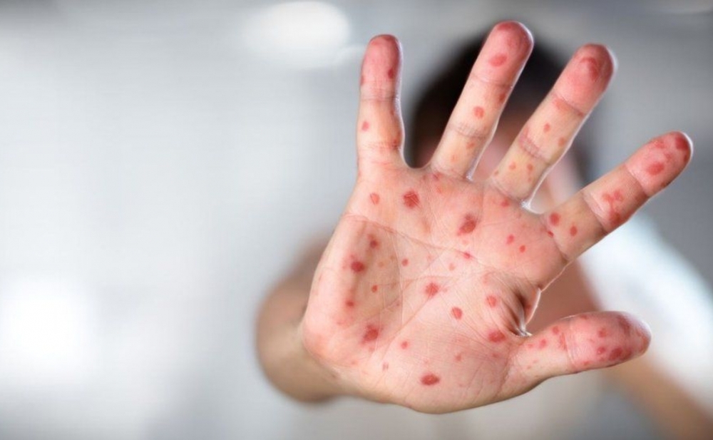Bu ölkədə qızılca epidemiya elan edildi