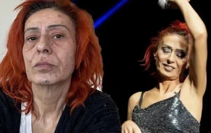 Yıldız Tilbenin üzü yanıb - Fotolar