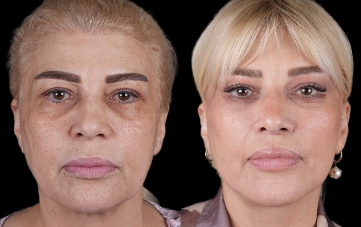 Mətanət İsgəndərli plastik əməliyyatdan əvvəl və sonra - Fotolar