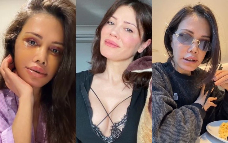 Keçmiş "Survivor" yarışmacısı əməliyyatla üzünü tamamilə dəyişdirdi