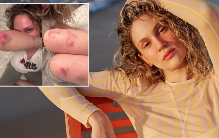 Farah Zeynep Abdullaha nə olub? - Foto