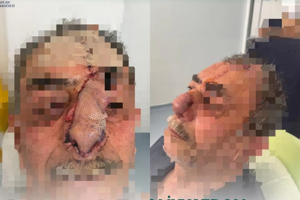 İtin parçaladığı burun bərpa edildi - Azərbaycanda unikal əməliyyat